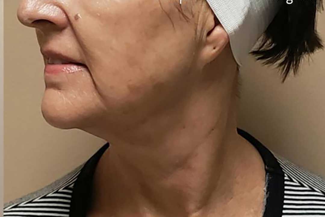 Woman with headband around neck, before and after treatment for skin condition.