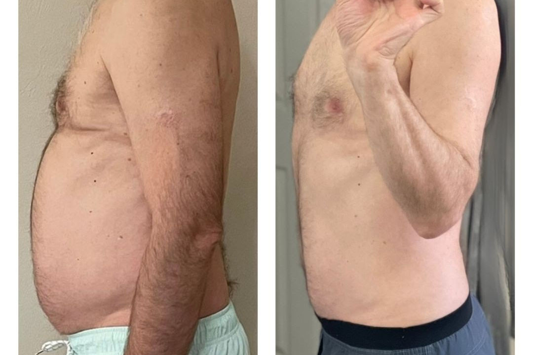 Incredible Results from Weight Loss, Liposuction & Morpheus8