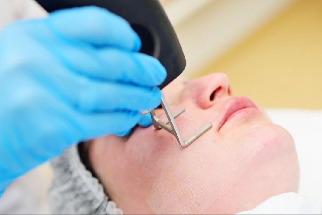CoolPeel The Treatment That Does What Your Skincare Cannot copy
